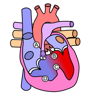 Heart tetralogy fallot