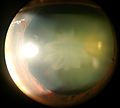 Rosette cataract
