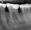 Abscessed tooth periapical radiograph