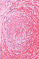 Fetal thrombotic vasculopathy - very high mag