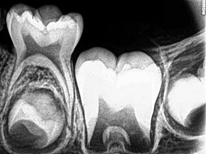 Intraoral Periapical Radiograph (IOPA) showing Deciduous(Milky or Primary) Tooth 75 and developing crown of Permanent or Secondary Teeth 35, 36 and 37