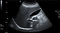 Gallbladder and common bile duct ultrasound