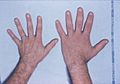Acromegaly hands