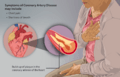 Depiction of a person suffering from Coronary Artery Disease