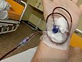 Blood transfusion B