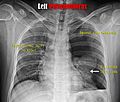 X-ray of pneumothorax signs