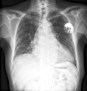 Chest xray pacemaker (CardioNetworks ECGpedia)