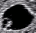 Embryo at 5 weeks 5 days with heartbeat