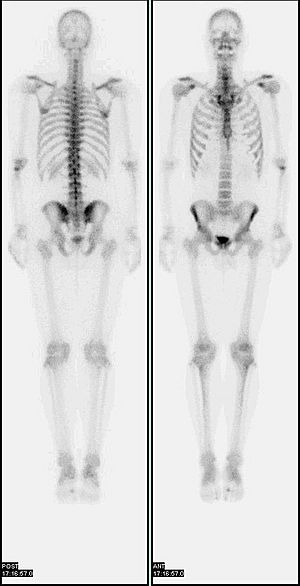 Nl bone scan2