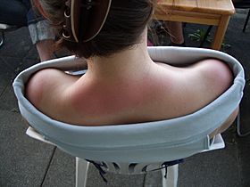 Sunburnt neck and shoulders