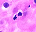 Histology of an eosinophil in esophageal epithelium