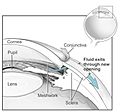 Conventional surgery to treat glaucoma EDA11