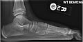 Lateral X-ray of a flat foot an C-sign