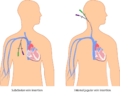 Percutaneous central venous catheters