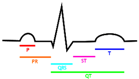 EKG complex