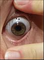 Scleral lens worn on an eye