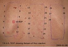 Result of standard T.R.U.E patch test showing allergy to Balsam of Peru
