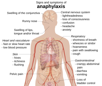 Signs and symptoms of anaphylaxis.svg