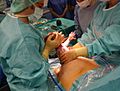 Caesarian section - Pull out