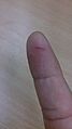 Finger cut