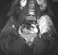 Ewing's sarcoma MRI nci-vol-1832-300