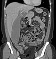 Enlarged gallbladder with gallstone and cholecystitis
