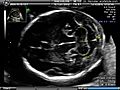 Cervelletto e cisterna magna ecografia ad ultrasuoni Dr. Wolfgang Moroder