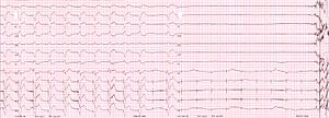 Pacemaker dependent asystole