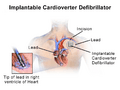 Blausen 0543 ImplantableCardioverterDefibrillator InsideLeads