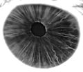 Fluorescein angiograpy of iris reveals radial layout of blood vessels