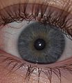 Blue eye featuring a Nevus in the Iris
