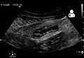 UOTW 45 - Ultrasound of the Week 3