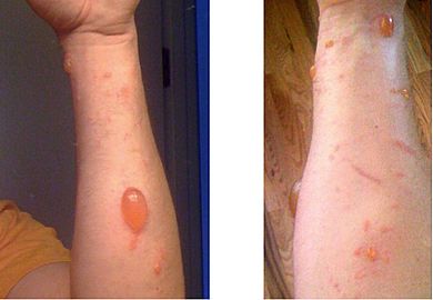 Urushiol induced contact dermatitis