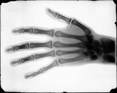 Buckwalter X-Ray Hand